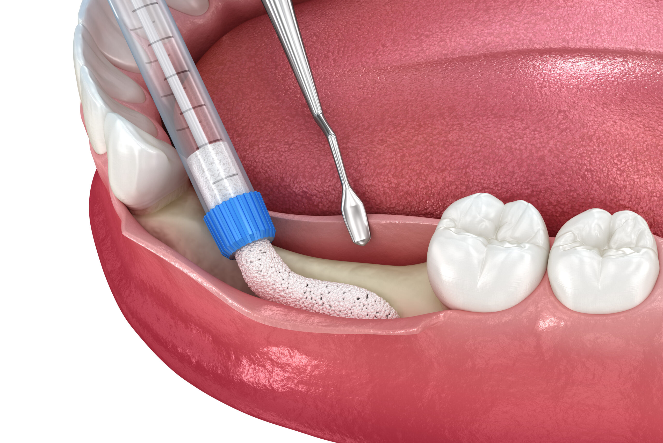 Bone Grafting