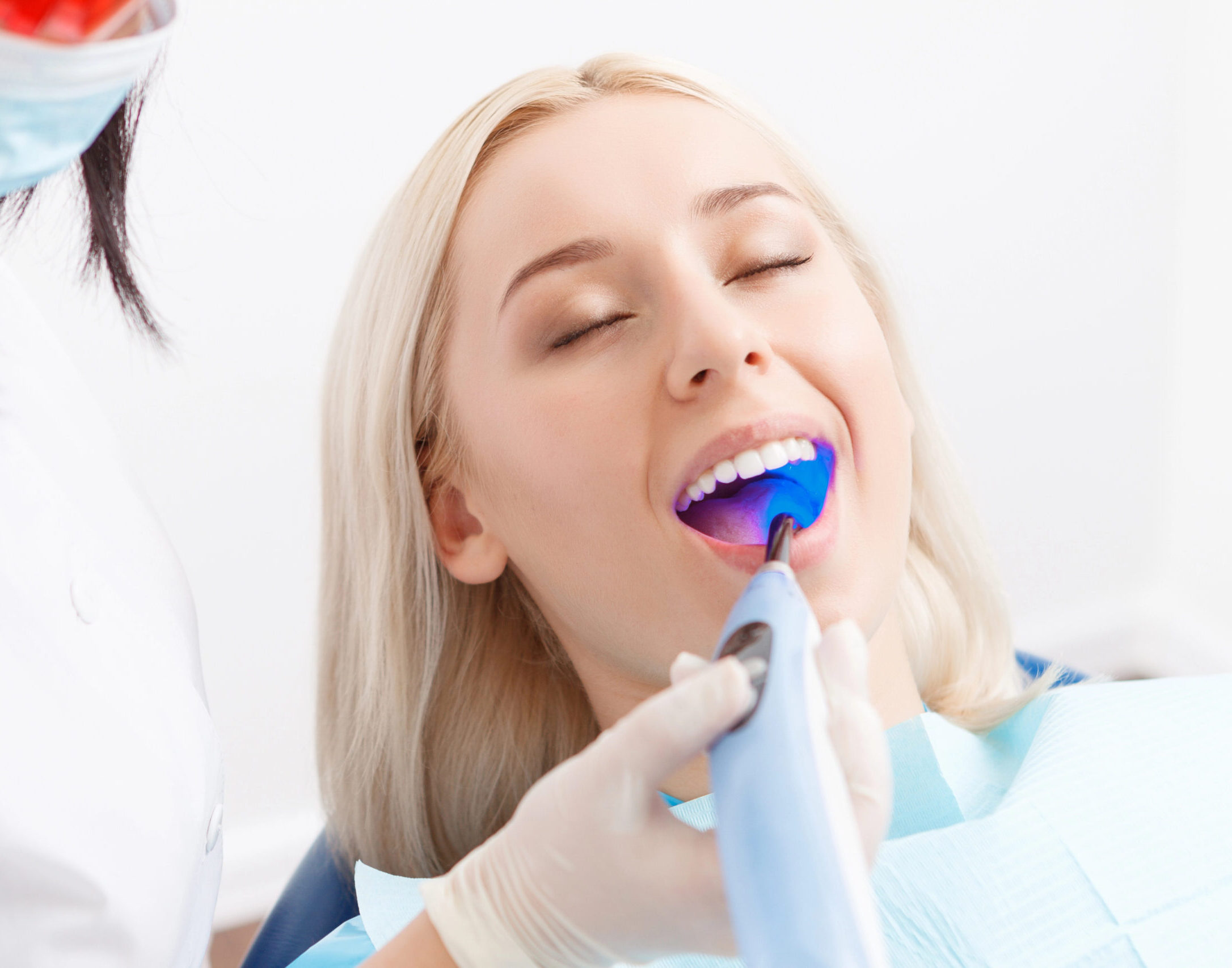 Dental Sealants